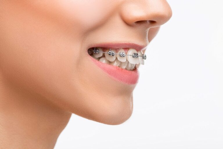 invisalign em Almada
